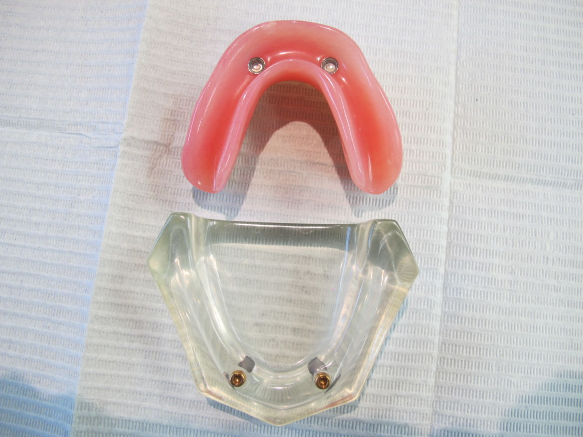 Implant Retained Lower Denture