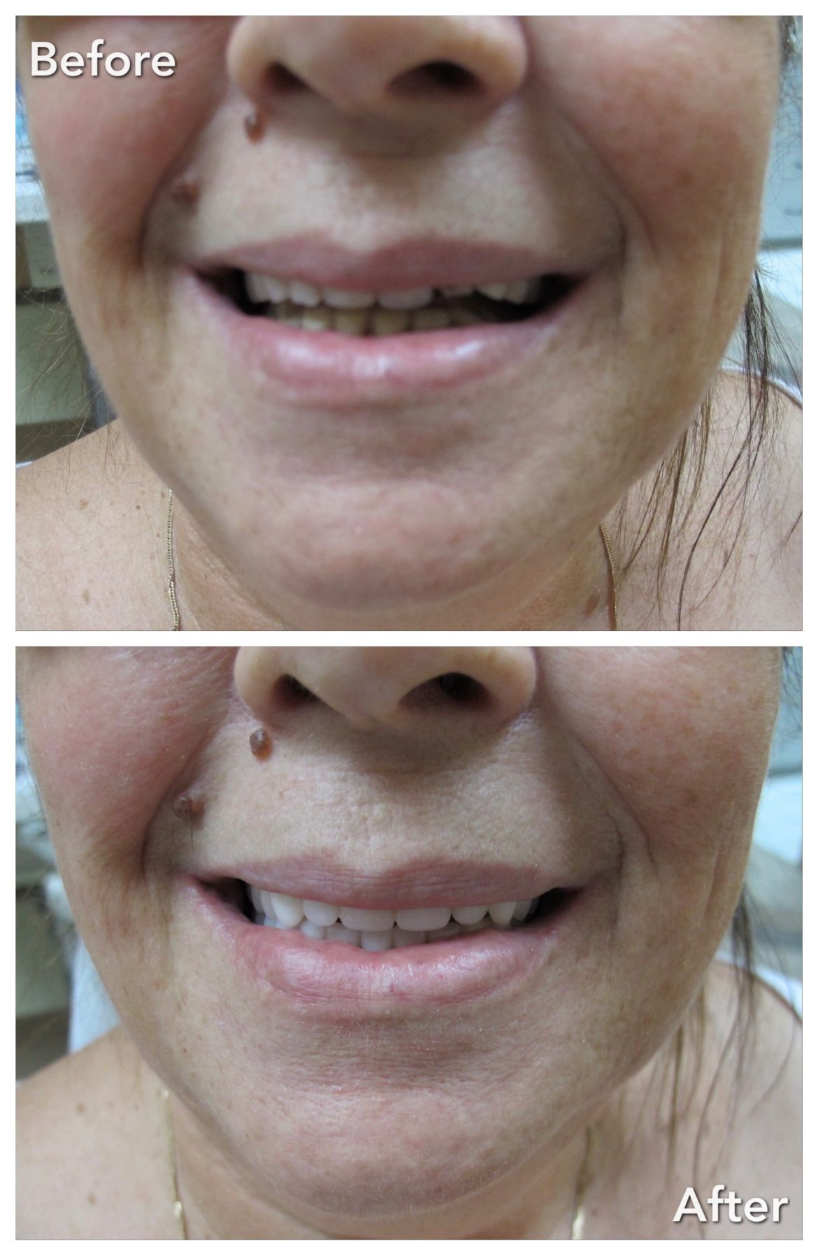 Complete Upper & Lower Treatment