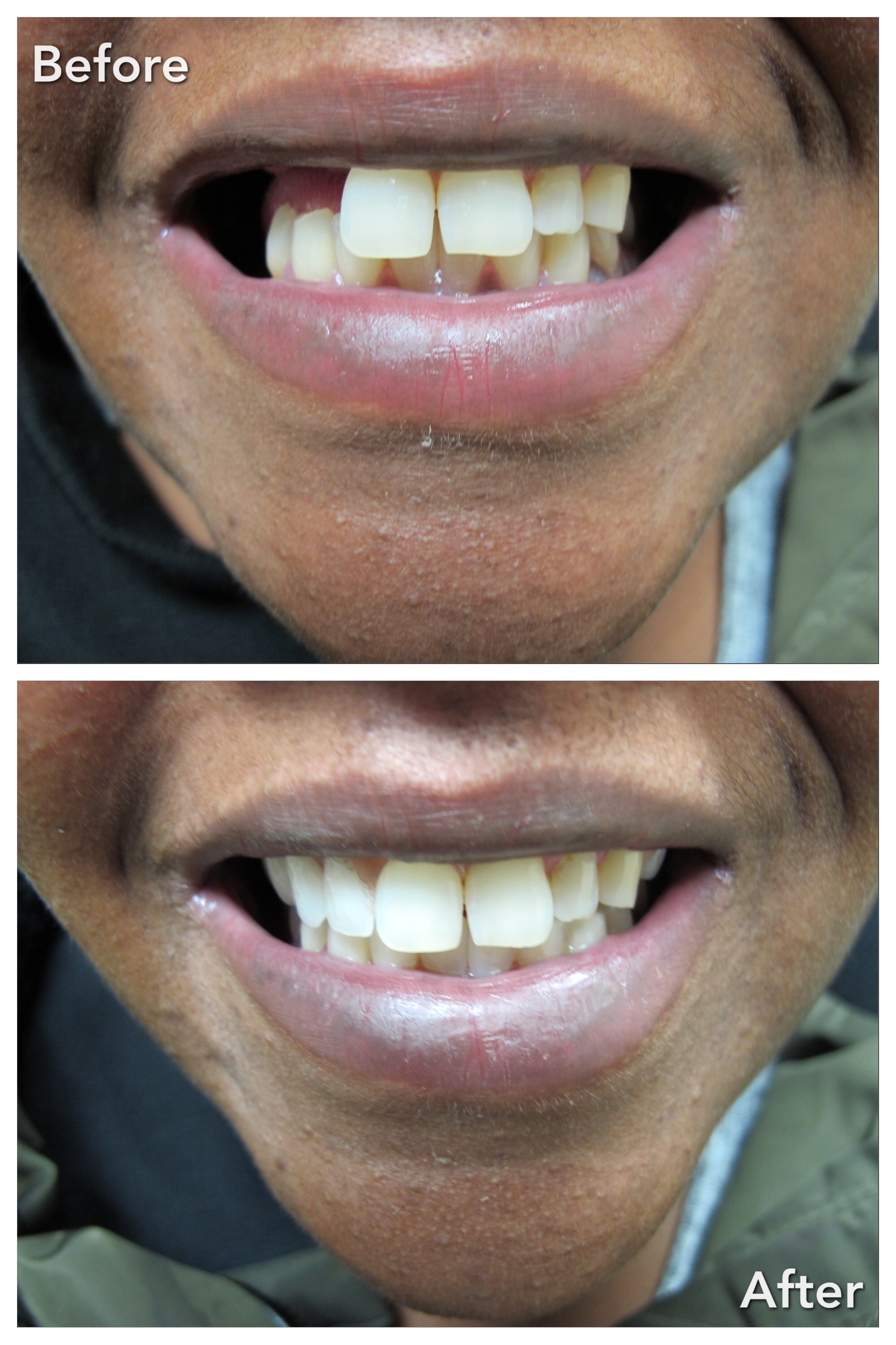 Partial Denture Treatment Baker Lanoue Denture Clinic