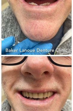 Complete Upper & Partial Lower Denture