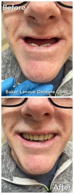 Complete Upper & Partial Lower Denture